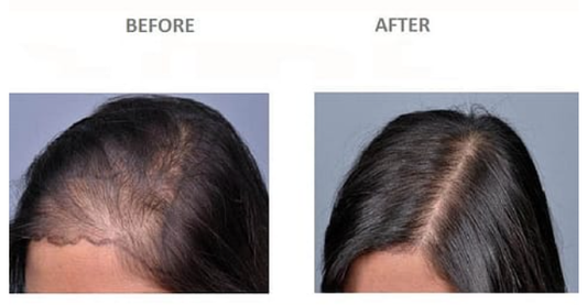 Celebrity Hair Transplant